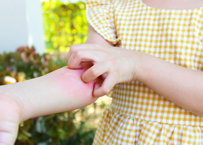 Alergias de pele comuns em humanos.