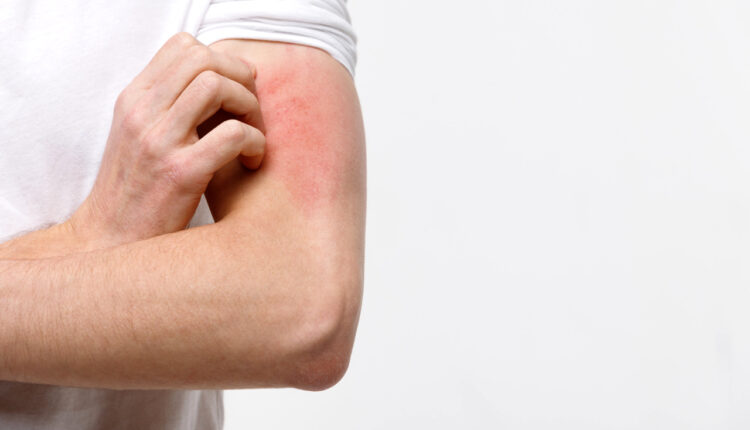 Alergias de pele muito comuns em humanos.