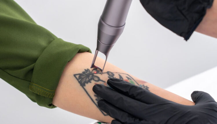 É possível remover tatuagem? Saiba como funciona o processo!