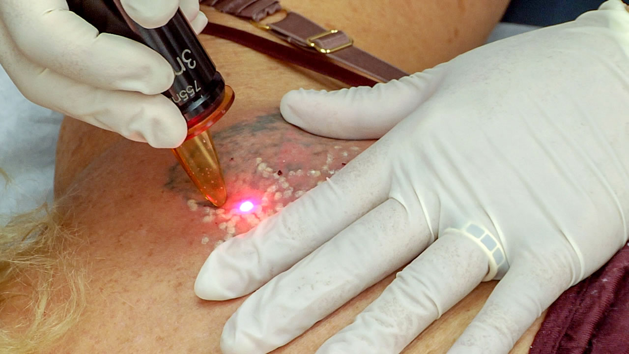 É possível remover tatuagem: procedimento a laser