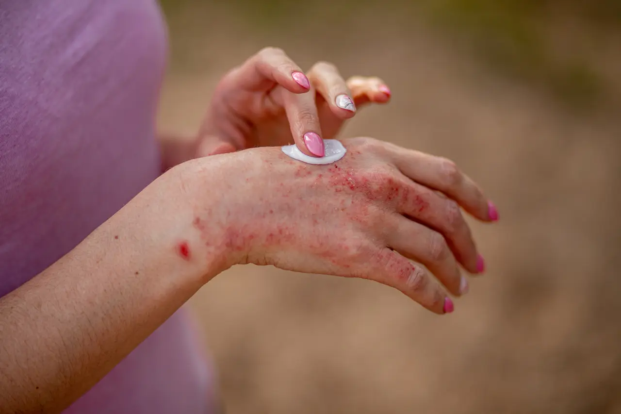 Diabetes sintomas na pele: dermatopatias e dermatites.
